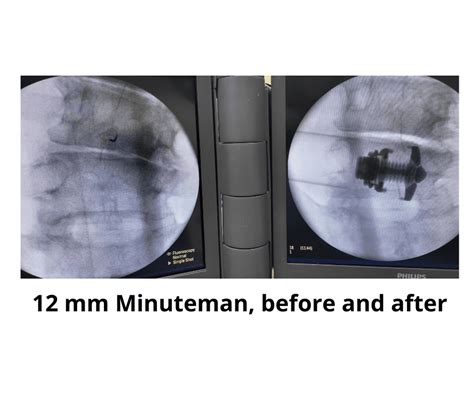 interventional radiology near union city